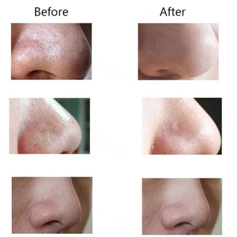 Pore Cleaning Device