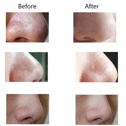 Pore Cleaning Device